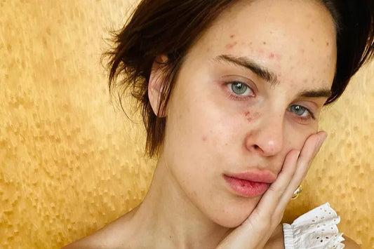 Talullah Willis has overcome her complusive skin-picking disorder